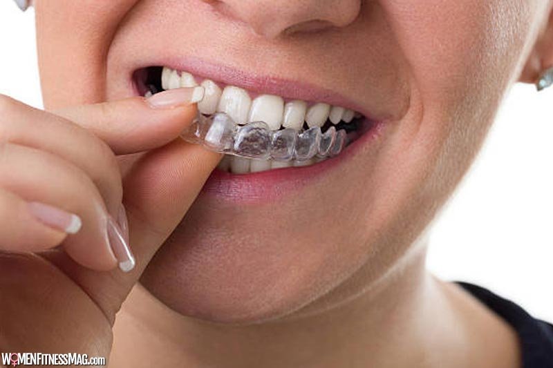 How to Achieve the Best Results from Teeth Aligners