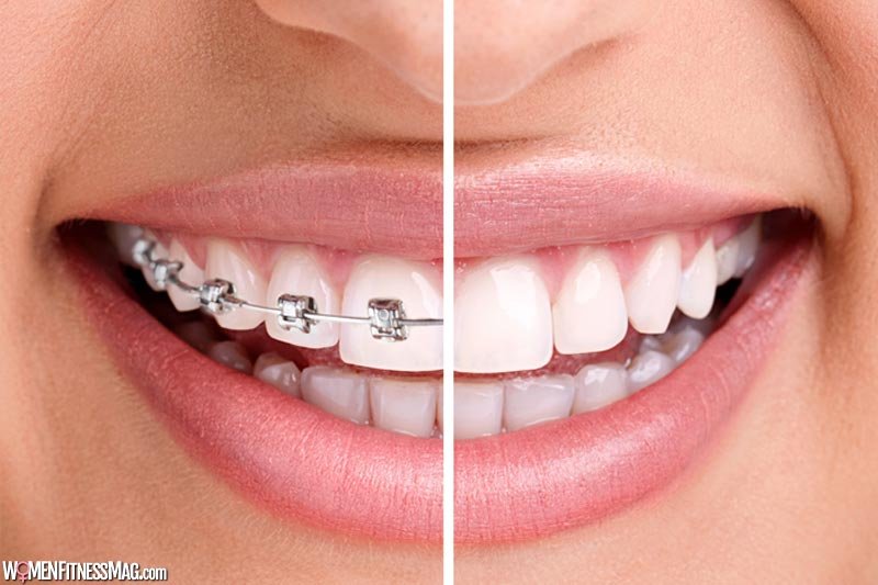 4 Tell-Tale Signs To Undergo Orthodontic Treatment
