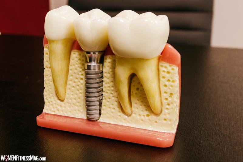 Are Dental Implants Safe? Learn the Advantages and Risks