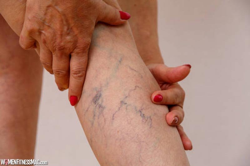 A Deep Dive Into Varicose Veins