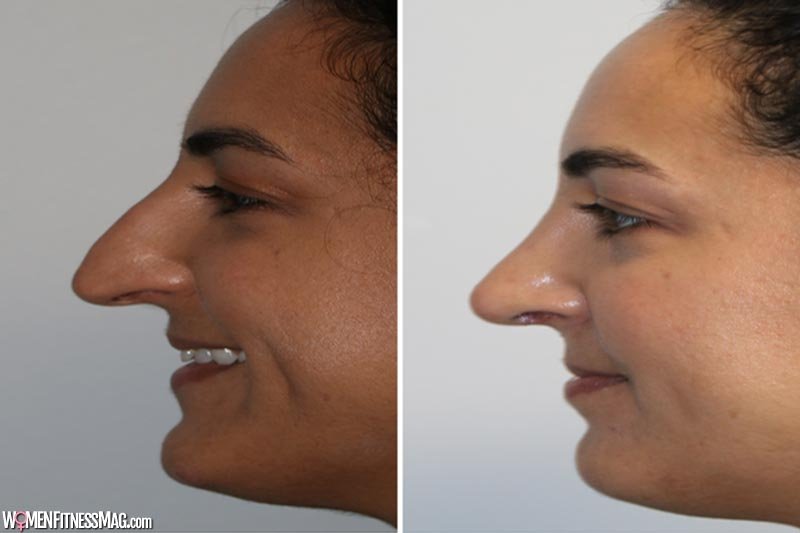 Undergoing facial cosmetic surgery