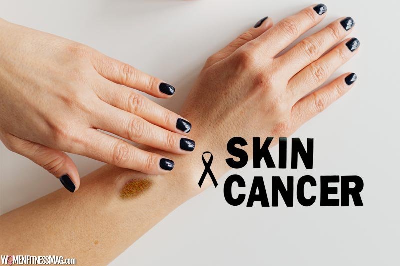 Why Is Melanoma The Deadliest Form of Skin Cancer?