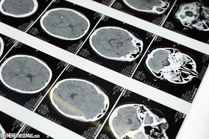 Traumatic brain injury lawyer: Everything you need to know