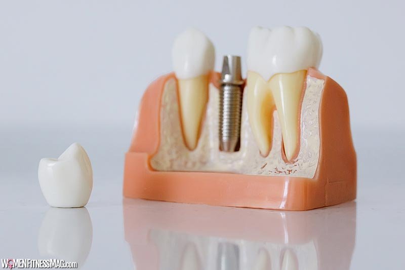 Dental Implants: Separating the Myths from the Facts