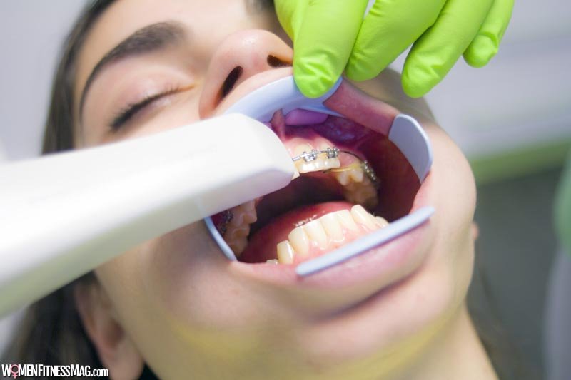 Dental Bonding: What It Is & What to Expect