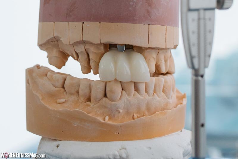 What You Should Know About Dental Bridges