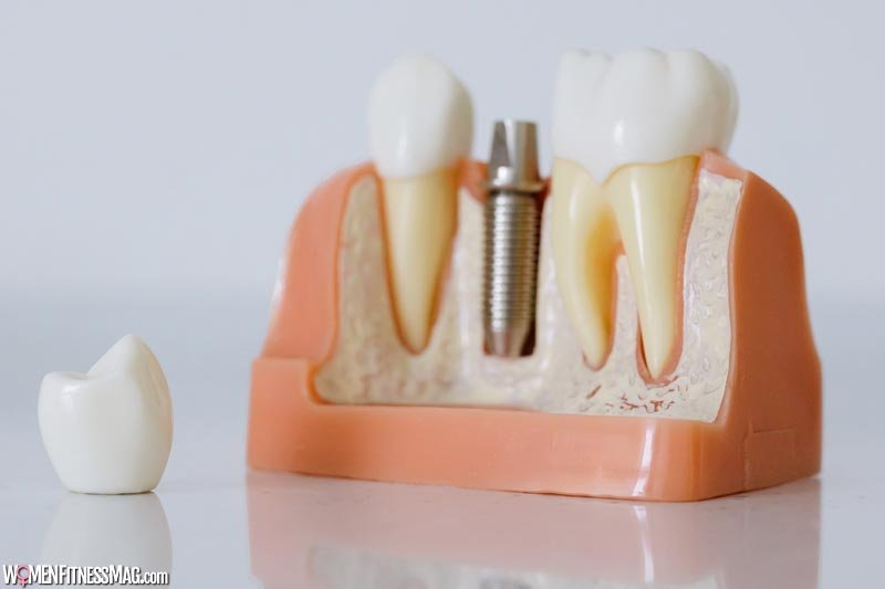 Mistakes To Avoid During Dental Implant Procedure
