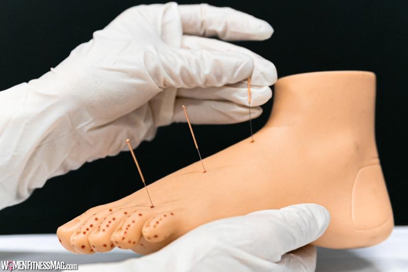 Does Acupuncture Work?