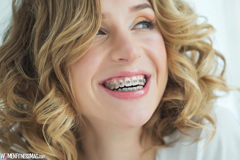 What Is The Best Type Of Braces For You?
