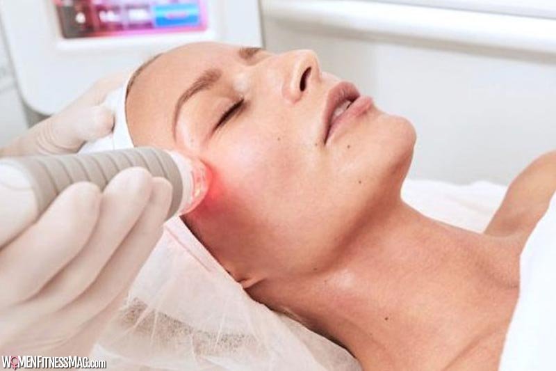 A Step By Step Guide to RF Microneedling: What to Expect