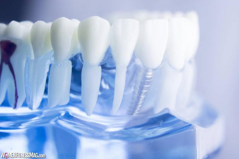 What Is the Process of Getting Dental Implants?