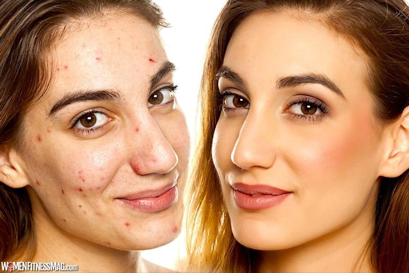 A Breakthrough Solution for Treating Stubborn Acne Like No Other