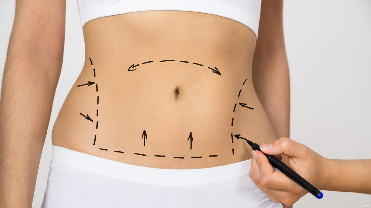 Achieving Your Ideal Body With Liposuction
