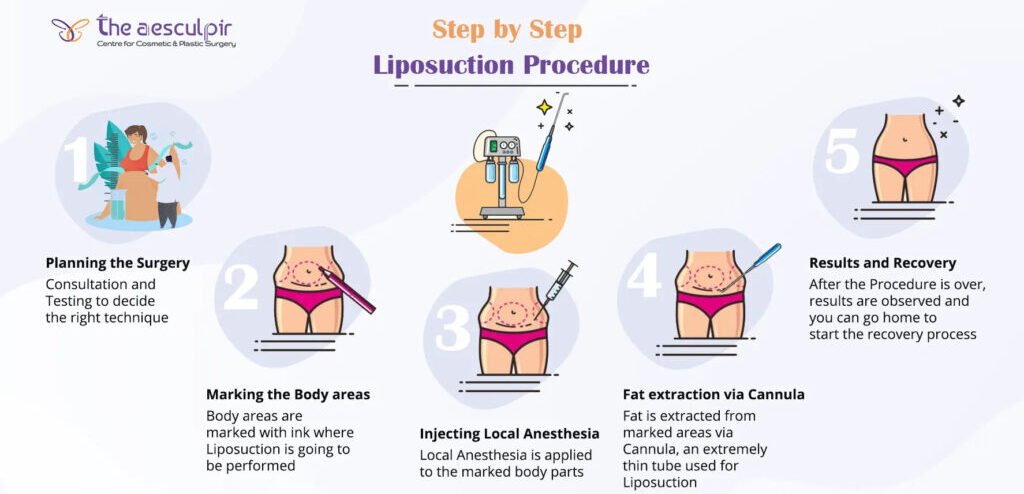 Liposuction step by step guide