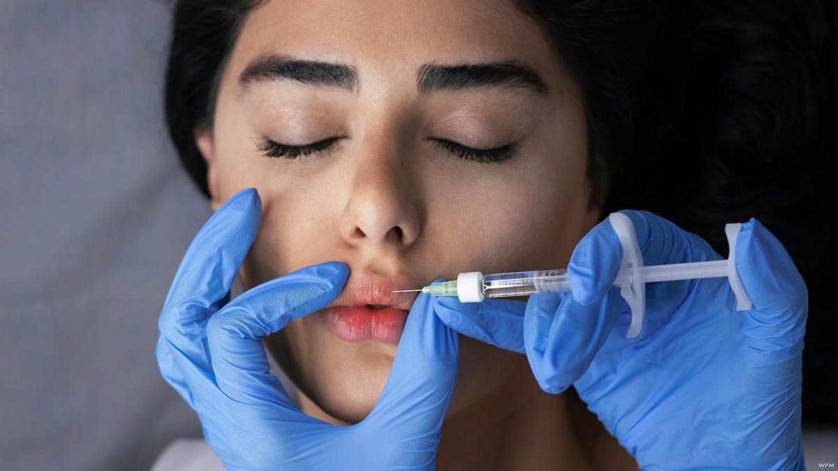 Lip Enhancement Myths: The Truth about Pain, Downtime, and Recovery